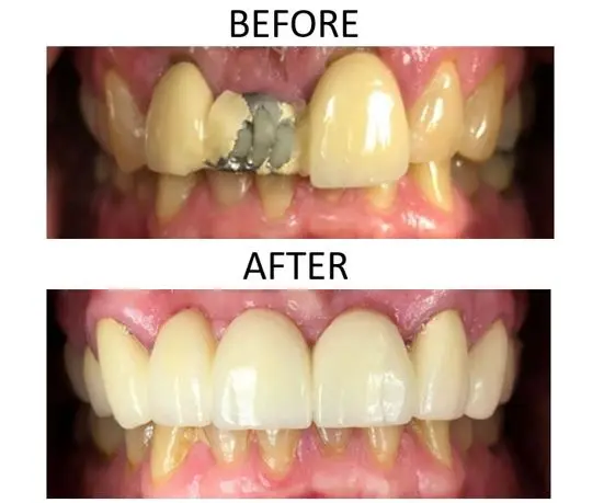 Before and after image