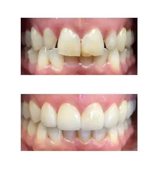 Before and after image