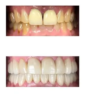Before and after image