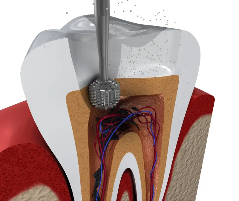 root canal therapy visualization edit root canal therapy visualization edit