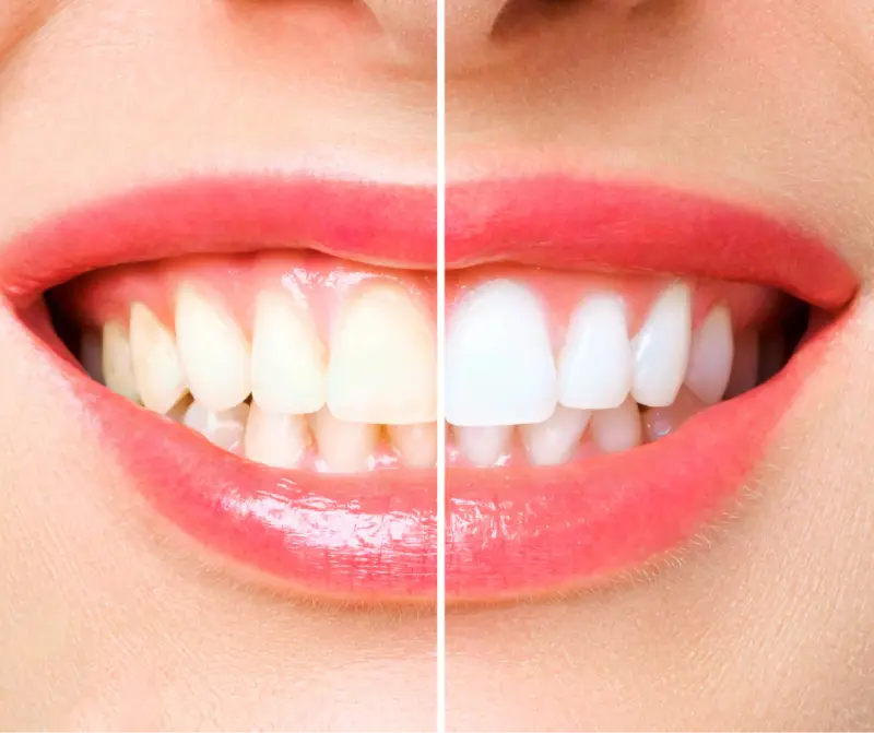 teeth whitening before and after down the middle teeth whitening before and after down the middle
