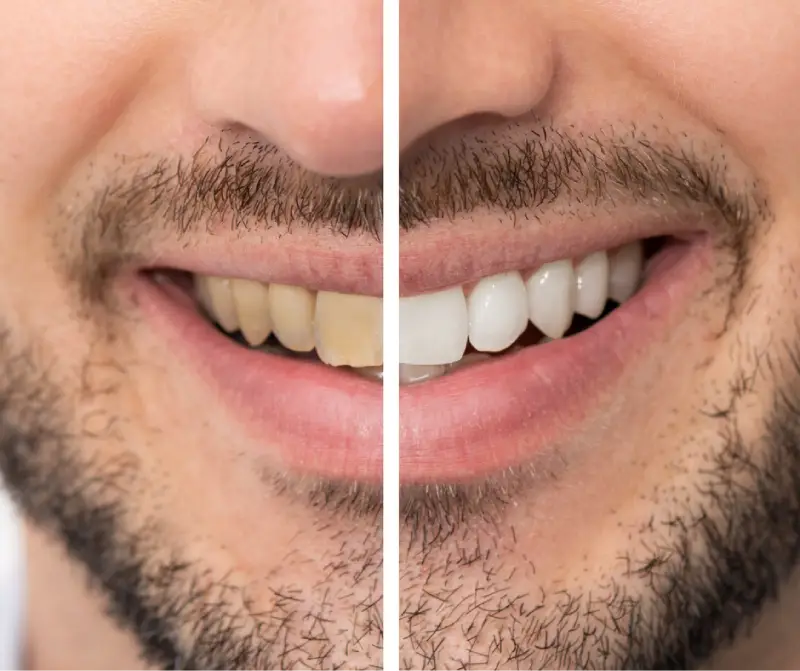 teeth whitening man before after down the middle teeth whitening man before after down the middle