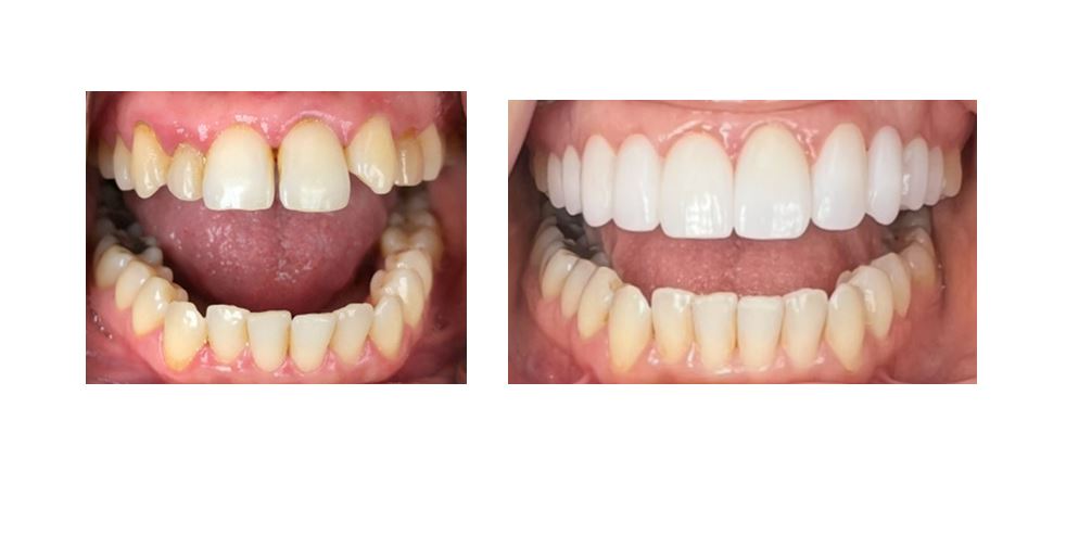 Completed smile