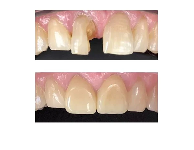 Photo-12 Teeth before and after example
